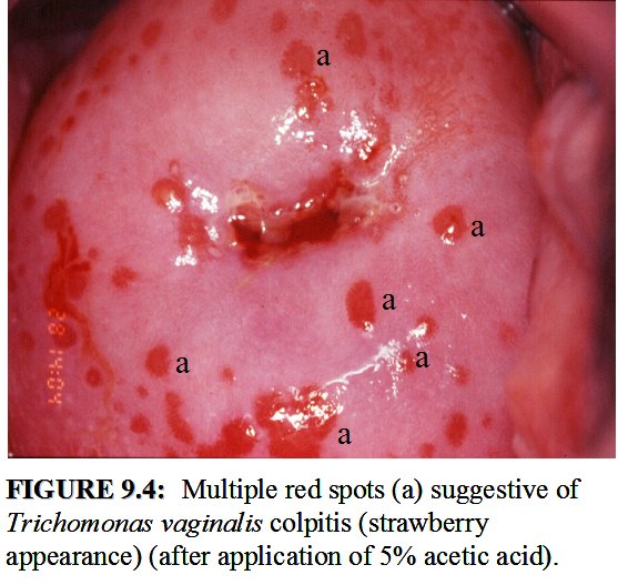 colpitis és Trichomonas opisthorchis toxoplasma