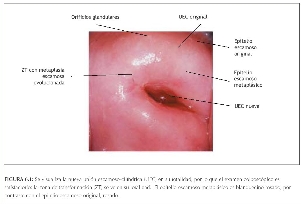 Metaplasia escamosa madura del epitelio de revestimiento endocervical