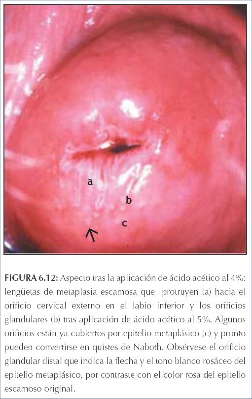 Intraductal papilloma with squamous metaplasia. Căderea părului papillomas