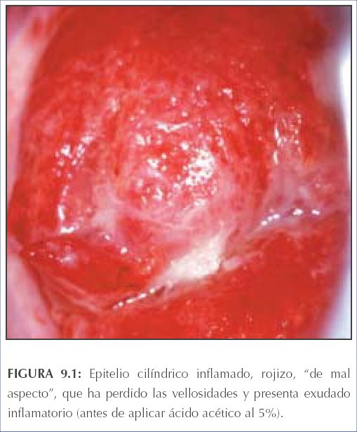La Colposcopia Y El Tratamiento De La Neoplasia Intraepitelial Cervical