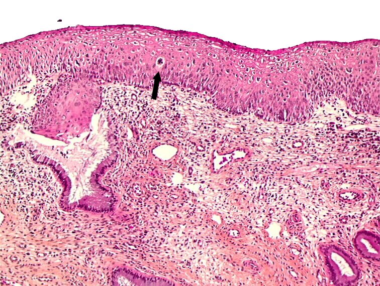 Condyloma epithelium. Vulvar condyloma