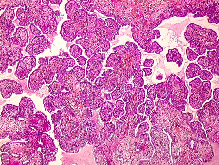 mullerian papilloma mik a férgek a gyermekeknél