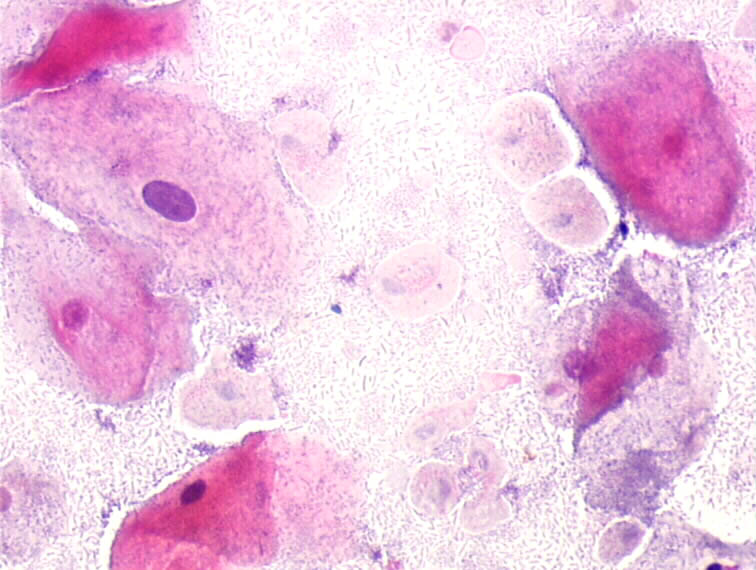 Trichomonas papilom. Protecție împotriva cancerului de col uterin (cervix uterin)