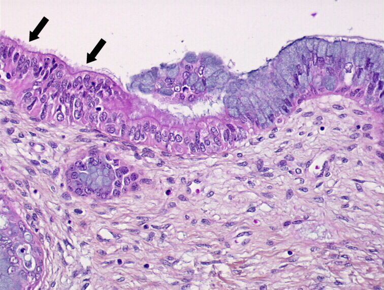 Рак матки гистология. Метаплазия гистология. Плоскоклеточная метаплазия эпителия бронха. Метаплазия шейки матки гистология.