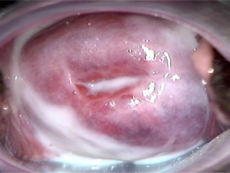 candidiasis vaginal discharge