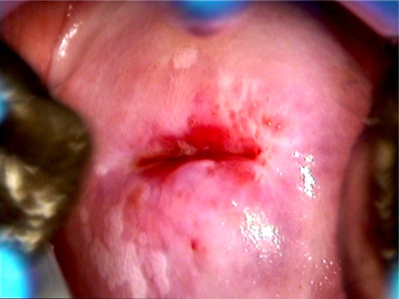 condilom cervical în omega 3 acne worse
