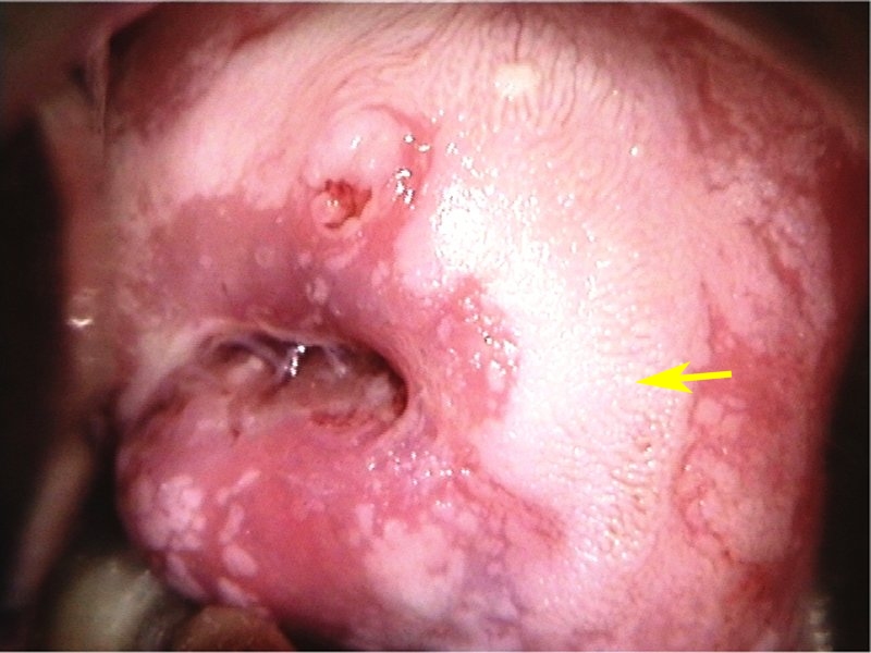 condilom cervical în are throat papillomas cancerous