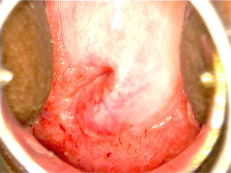 neoplazma a condyloma bőrén