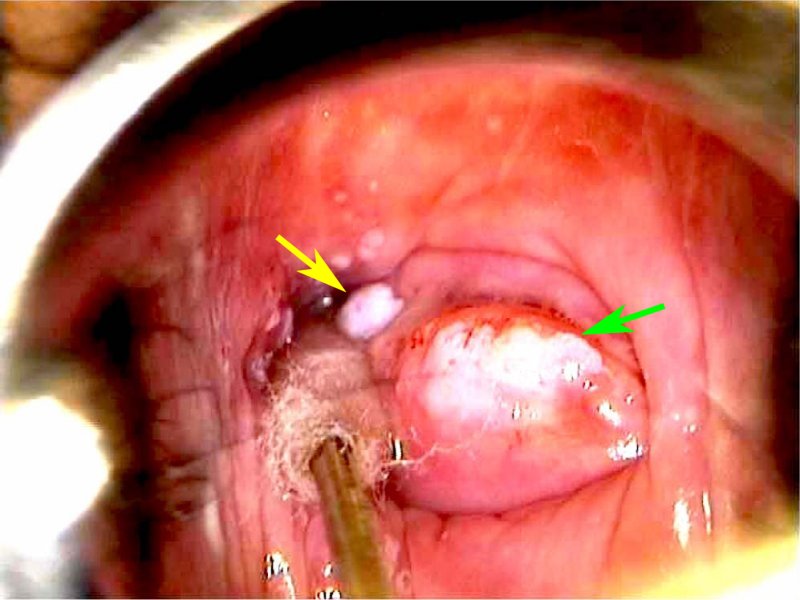 papilloma condyloma leukoplakia