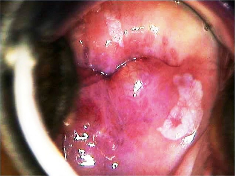 papilloma condyloma leukoplakia