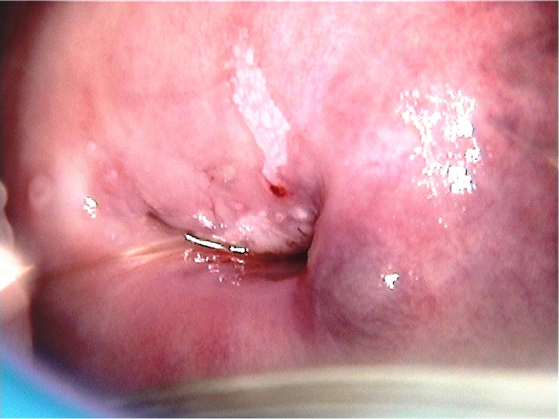 neoplazma a condyloma bőrén