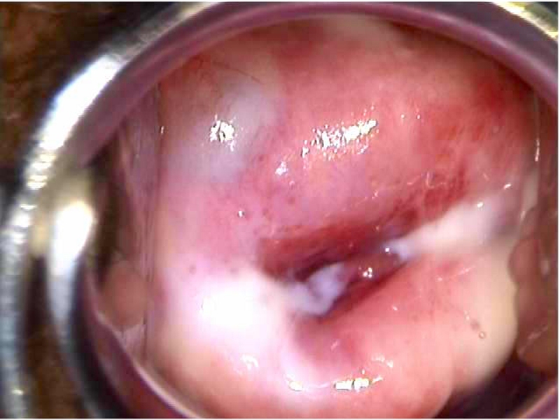 candidiasis vaginal discharge