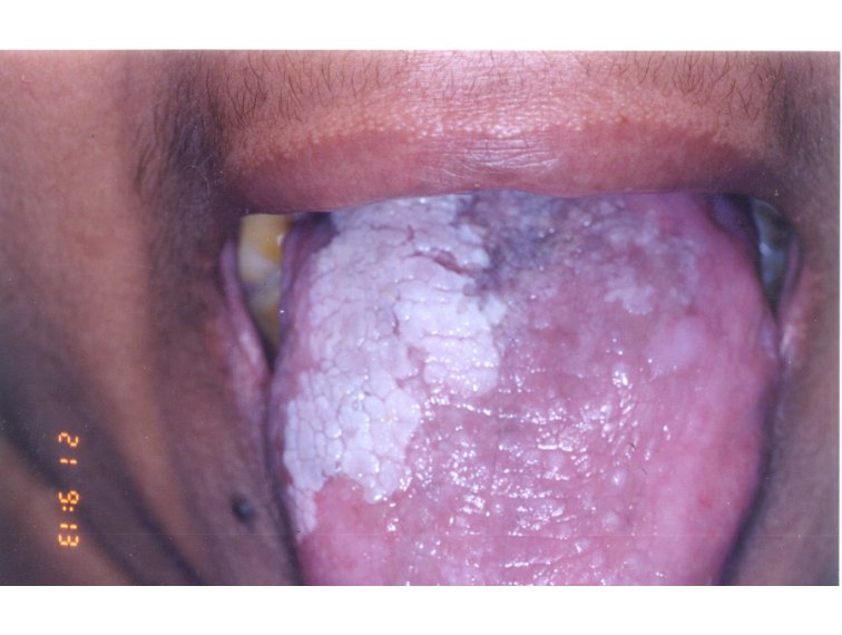 HIV-fertőzés tünetei a szájban? - Az orvos válaszol, Leukoplakia condilom