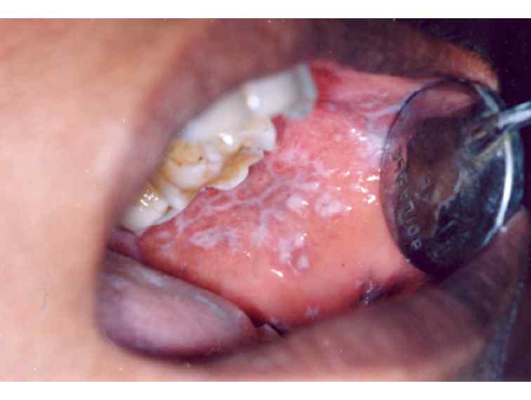Oral lichen planus (OLP) .