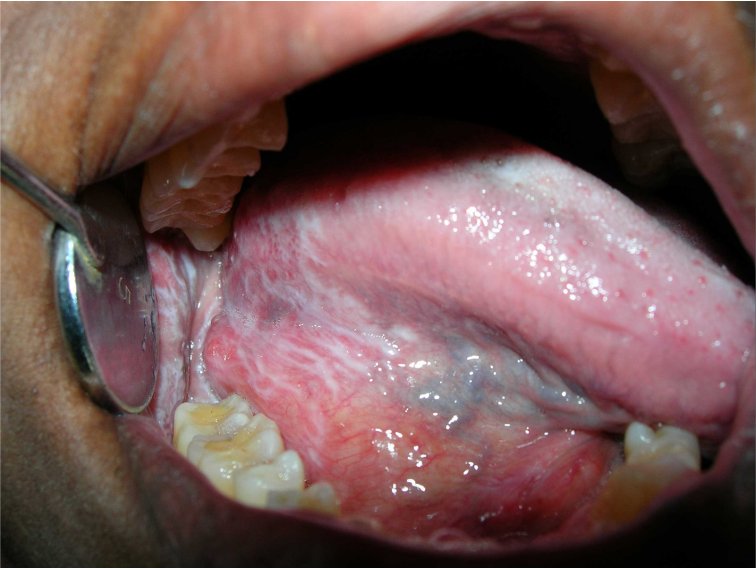 reticular oral lichen planus