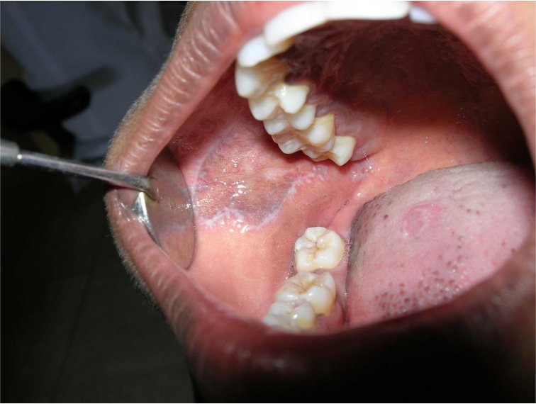 reticular oral lichen planus