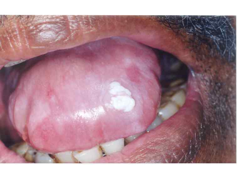 Diagnostic Features Of Common Oral Ulcerative Lesions