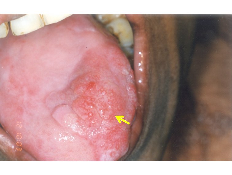 early squamous cell carcinoma mouth