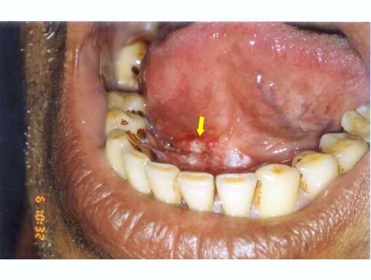 early squamous cell carcinoma mouth