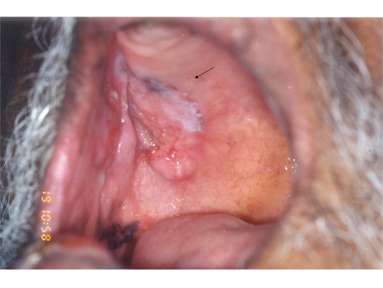 pictures-of-oral-cancer-palate