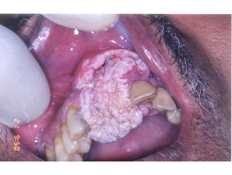 What does florid papillomatosis mean