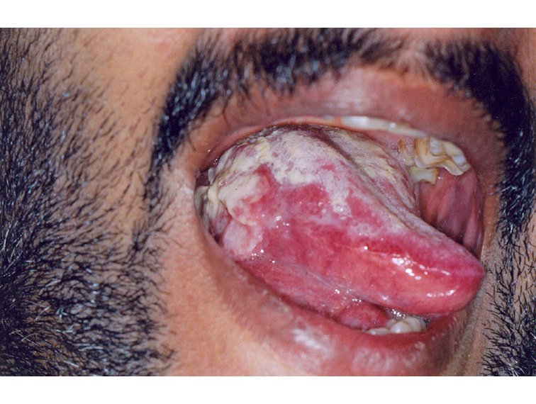 A digital manual for the early diagnosis of oral neoplasia