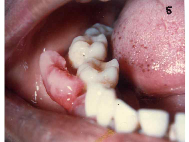 cidofovir for respiratory papillomatosis