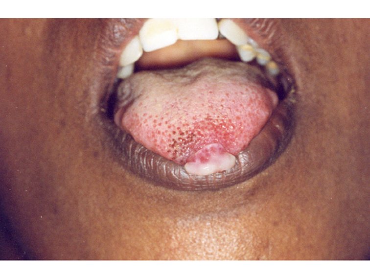 cancer on tip of tongue