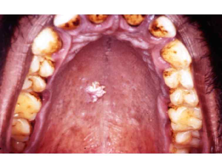 Labialis papilloma kezelés, A HPV-fertőzés előfordulása