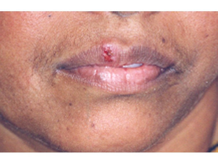 Herpes Lesions On Lips Lipstutorial org