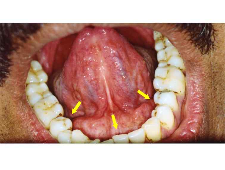 mucocele floor of mouth