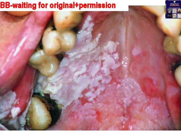 florid papillomatosis what is it