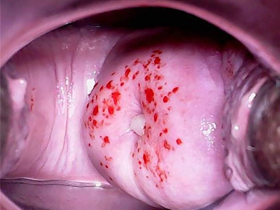Condiloame pe colul uterin la femei - HPV - cauze, simptome tratament