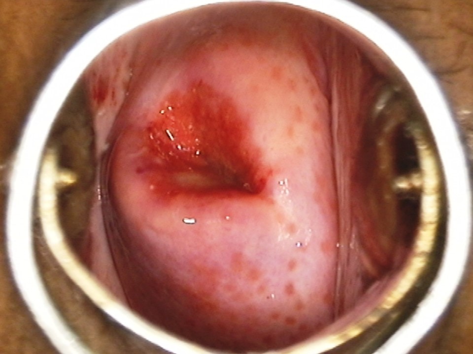 Atlas of visual inspection of the cervix with acetic acid for screening  triage and assessment for treatment